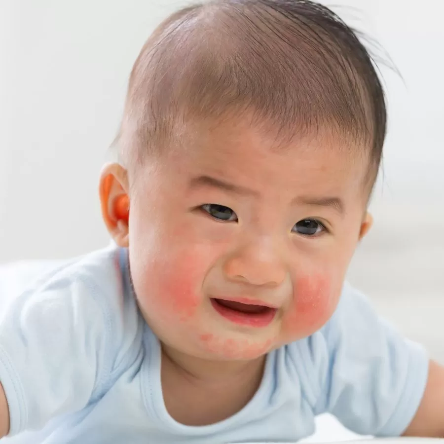 Muốn con hết ngứa ngáy, nổi mề đay. Mẹ chỉ cần áp dụng đúng cách chăm sóc này